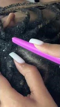 Dandruff Picking from Seborrheic Dermitis Scalp PT.1