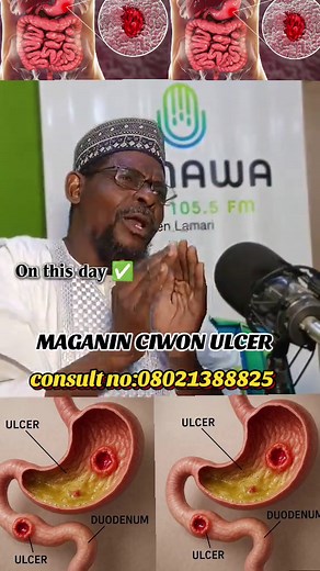 Understanding Ulcers: Types and Symptoms