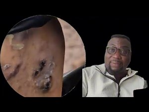 Deep Jigger Extraction | Heel Cleaning Therapy W03606Y