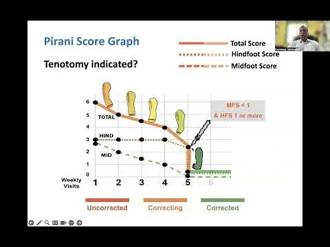 Pirani score in Clubfoot