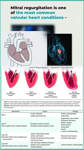 Abdallah Othman on Instagram: "Mitral Regurgitation - Carpentier Functional Classification Type I - Normal leaflet motion Type II - Excess leaflet motion (leaflet prolapse) Type III - Restricted leaflet motion Type Illa - Restricted leaflet motion during diastole and systole; Type 111b - Restricted leaflet motion predominantly during systole #Mitral #Regurgitation #Carpentier #valvularheartdisease #Classification #diagnosis #cardiology"
