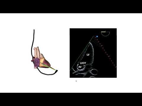 How to perform a transeosphageal echo (TOE)
