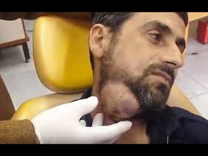 #032 | 1 HOUR OF THE BIGGEST BLACKHEADS & PIMPLES POPPED! | Extreme Extraction Video