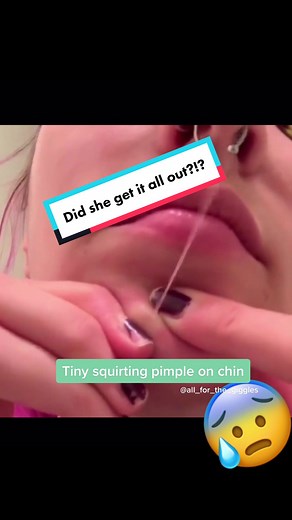 Chin Pimple Squirting Video