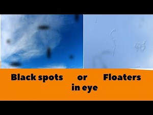 Black spots or floaters in eyes | Opthalmology