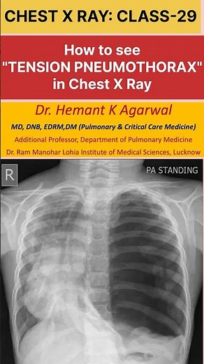 CXR-29: TENSION PNEUMOTHORAX- How to see in Chest X Ray PA view ‪@dr.hemantkumaragarwal-pccm7789‬