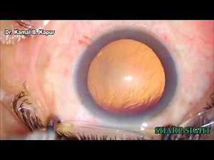 Best video for Topical phaco emulsification step by step By Dr. Kamal Kapur