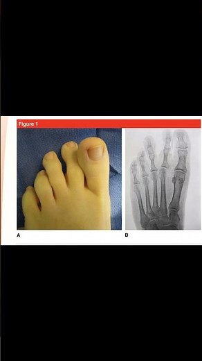 Lachman’s Test of the Foot 🦶 | MTP Joint Instability Exam #podiatry #ortho #meded #aTC #physio