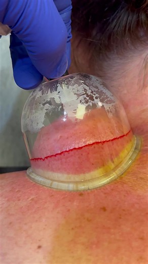 🏆 Cupping therapy decompresses fascia and muscle to improve circulation, reduce stiffness, and support recovery. #Cupping #DrKyleRoss #chiropractor