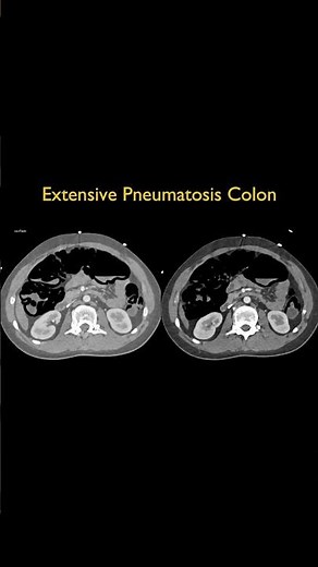 Extensive Pneumatosis Colon