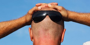 This Guy's Severe Sunburn Created A Giant Dent In His Head