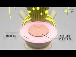 Lumbar Disc Prolapse and Epidural Injection by Dr Krishna