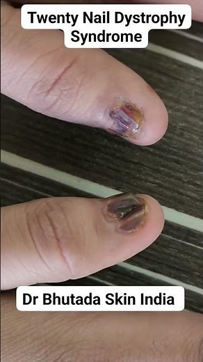 Nails Dystrophy Syndrome #dr Bhutada Skin India