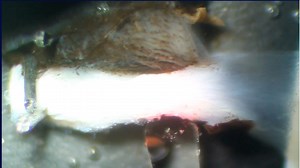 Transcleral Micropulse Laser Dynamically Alters Ciliary Muscle and Aqueous Outflow Pathways - Eyetube