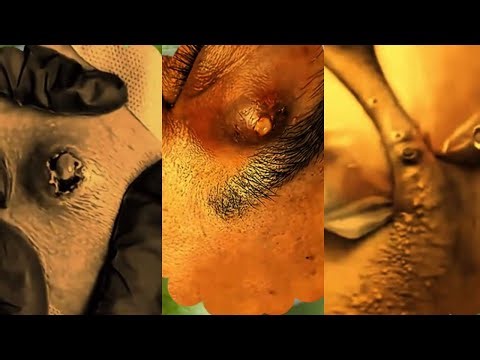 Satisfying Pimple Popping ASMR — Huge Zit & Blackhead Removal | 045