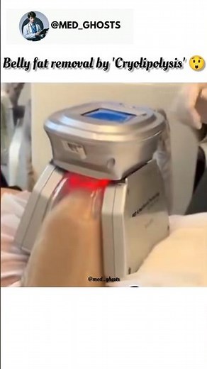 Belly fat removal by 'Cryolipolysis' 😲 #science #fatloss