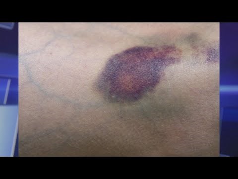 Do You Bruise Easily? Learn How to Prevent and Fade Them!