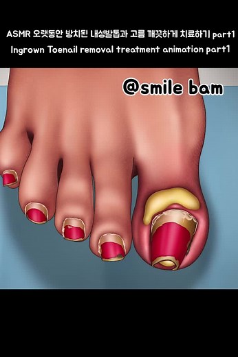 #smilebam #애니메이션 #내성발톱 #asmr #care #ingrowntoenail #scaling #satisfying #soonent