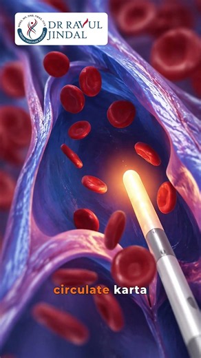 Radiofrequency Ablation (RFA) for Varicose Veins | How It Works & What to Expect