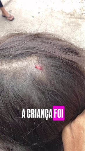 Bruno Ferreira on Instagram: "Acidente com placa de sinalização em Mariana MG! Aconteceu nessa sexta feira 13 fev 2026 um incidente com criança que ficou ferida ao ser atingida por placa de sinalização acertando a cabaça da mesma provocando ferimentos leves na mesma! Esse fato aconteceu na Vila Maquine próximo ao BH. Atenção @prefmariana @juliano_duarte"