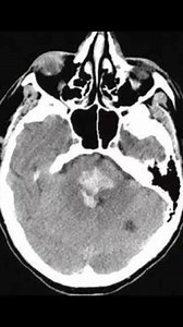 A 49-year-old man was found comatose on the street. His CT scan is shown. Which of the following breathing patterns is most likely to be seen in this patient? A. Rapid, regular respirations at 60 breaths/minute B. Deep, labored, gasping breaths at 20 breaths/minute C. Cycles of progressively deeper breaths that then slow down, ending in a period of apnea D. A prolonged inspiratory gasp with a pause at full inspiration E. Deep, regular breaths only 4 to 5 times per minute | Neurology