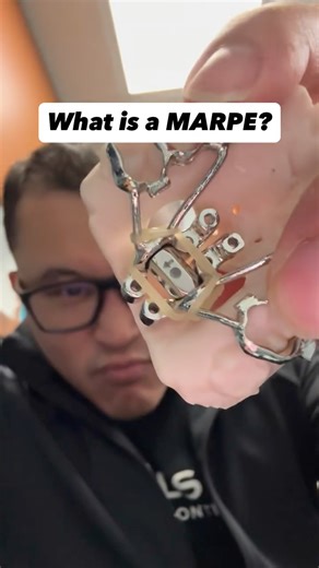 Dr. Minh Nguyen | Orthodontist on Instagram: "Missed the window for expansion as a kid? That’s exactly where MARPE comes in. A MARPE (Miniscrew-Assisted Rapid Palatal Expander) is designed for teens and adults who still need space but are past the point where a traditional childhood expander will work. This appliance doesn’t just move teeth — it creates skeletal expansion using 4–8 tiny miniscrews. And the best part? MARPEs aren’t one-size-fits-all. There are multiple designs, each custom-built 