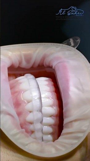 Occlusal Splint for a Bruxism Patient | Dr. Rami Albahri