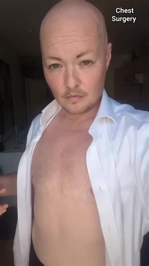 Understanding Chest Surgery for Transgender Men