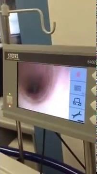 Flexible endoscopic self-intubation