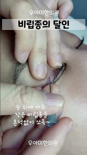 비립종 압출 피부과 달인 원장 방법은?레이저 흉터없이 씨앗만!