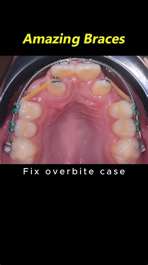 Amazing braces. Fix buck teeth process #braces #orthodontist #dentist