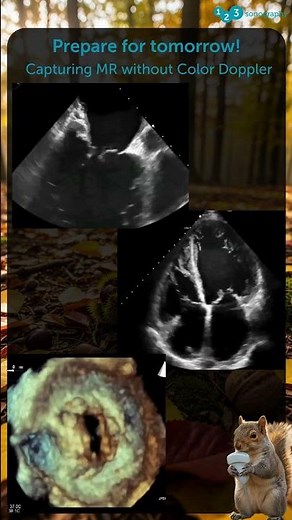 Do we always need color Doppler to detect and grade mitral regurgitation? 🧐❔🐿