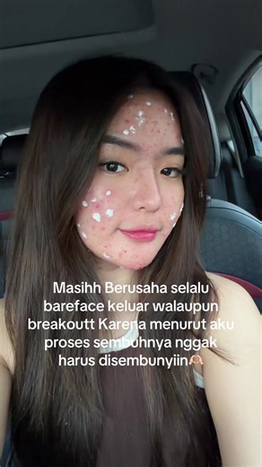 Rutinitas Bareface Saat Breakout: Jaga Kulit dan Percaya Proses