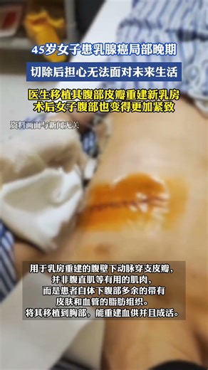 45岁女子患乳腺癌局部晚期，切除后担心无法面对未来生活，医生移植其腹部皮瓣重建新乳房，术后女子腹部也变得更加紧致