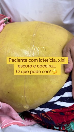 A icterícia é caracterizada pela coloração amarelada da pele e dos olhos devido ao acúmulo de bilirrubina no sangue. As principais causas incluem: \t1.\tAlterações no fígado: doenças como hepatite, cirrose e fígado gorduroso que comprometem o metabolismo da bilirrubina. \t2.\tObstrução das vias biliares: cálculos biliares, tumores ou inflamações que impedem o fluxo da bile. \t3.\tAumento da destruição de hemácias: condições como anemia hemolítica, talassemia ou reações transfusionais. \t4.\tIcte