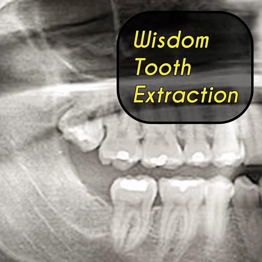 Upper Wisdom Tooth Extraction