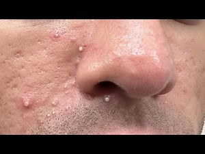 HOW TO GET RID OF WHITEHEADS SUPER FAST