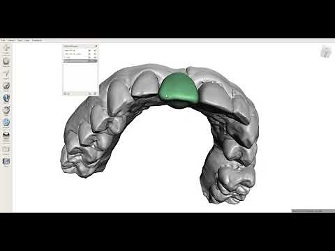 MeshMixer - Single Tooth Waxup - 2 Techniques