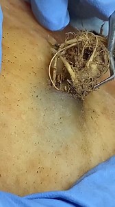 111K views · 348 reactions | Top Pops Compilation — BEST of MrPopZit #toenails #pedicure #OddlySatisfying #fblifestyle #fypシ Beautiful moments of care and relaxation through a gentle pedicure experience. Simple, clean, and satisfying. ￼ ￼ Disclaimer: This video is for educational and relaxation purposes only. All content belongs to the respective owners, no copyright infringement is intended. | Help remove ticks | Facebook