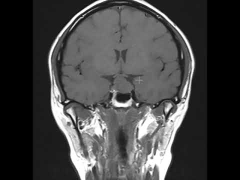 Pituitary macroademoma that compresses the optic chiasm