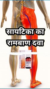 Best Homeopathic medicine for sciatica , Dr recweg for sciatica Homeopathic medicine for sciatica #aarogyaclinic #homeopathy #healthcare #holistichealth #health #sciatica #painrelief #belladonna #drrecweg #SBL #Fever Dr. Deepak Singh | Dr. Deepak Singh