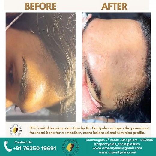 Frontal Bossing Reduction Surgery by dr Pentyala’s #drpentyala #facialfeminization #maletofemale