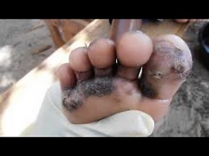 Our village mission trip to treat jiggers