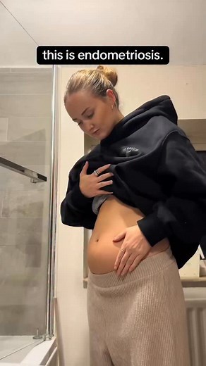 145K views · 1.8K reactions | Chronic bloating in women is often misunderstood and misdiagnosed and can often be the sentinel sign of complex conditions like endometriosis. P.S comment “VITAL” if you want to read more about endometriosis, women’s health conditions and other things that aren’t spoken about or researched enough…I cover it all in my upcoming book “This Is Vital Information” (pre-order!) | Dr Karan | Facebook