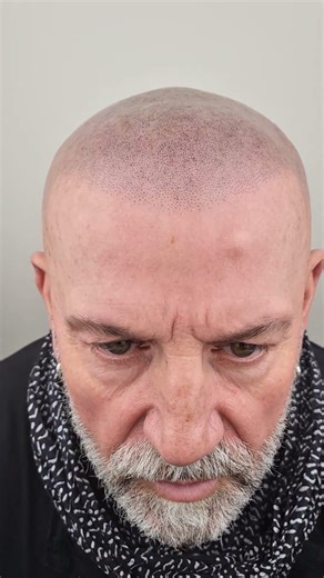Scalp Micropigmentation In Kent, SMP, Scalp Tattoo, Hair Tattoo, Men's Hair Loss Solution In Kent.