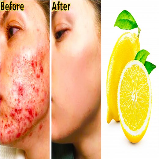 Lemon juice acts as a natural bleaching agent that helps remove stubborn tan. To make this tan removal, all you have to take is squeeze some fresh lime and mix it with honey. You can add some sugar, prefer the fine one, and scrub your face using the paste. | Health Tips
