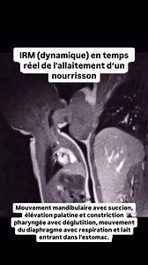 Cette vidéo d’IRM dynamique est issue d’une étude observationnelle prospective pour évaluer la déglutition chez les nourrissons. L’IRM dynamique permet de visualiser en temps réel les mouvements internes du corps, y compris ceux de la gorge et de l’œsophage pendant la déglutition. Une aide précieuse pour les médecins afin de mieux comprendre et diagnostiquer les problèmes de déglutition chez les nourrissons et d‘améliorer leur prise en charge. Source: Imaging the breastfeeding swallow: Pilot stu