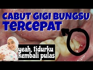 GIGI BUNGSU TUMBUH TERTUTUP GUSI!!! ini proses dicabutnya