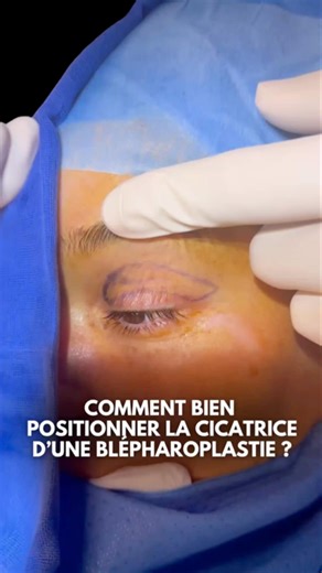 Comment bien positionner la cicatrice d’une blépharoplastie 👆🏻 #plasticsurgery #fyp .#pourtoi