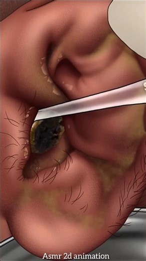 😯Giant Ear Wax Removal ASMR Animation😯Super Deep Cleaning#earcleaning #earwaxremova